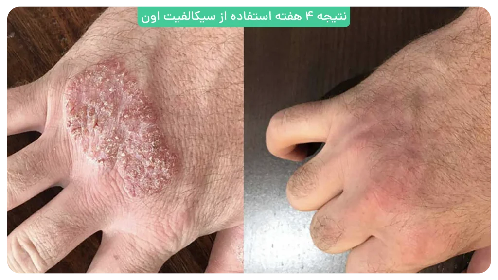 کرم ترمیم کننده سیکالفیت پلاس اون