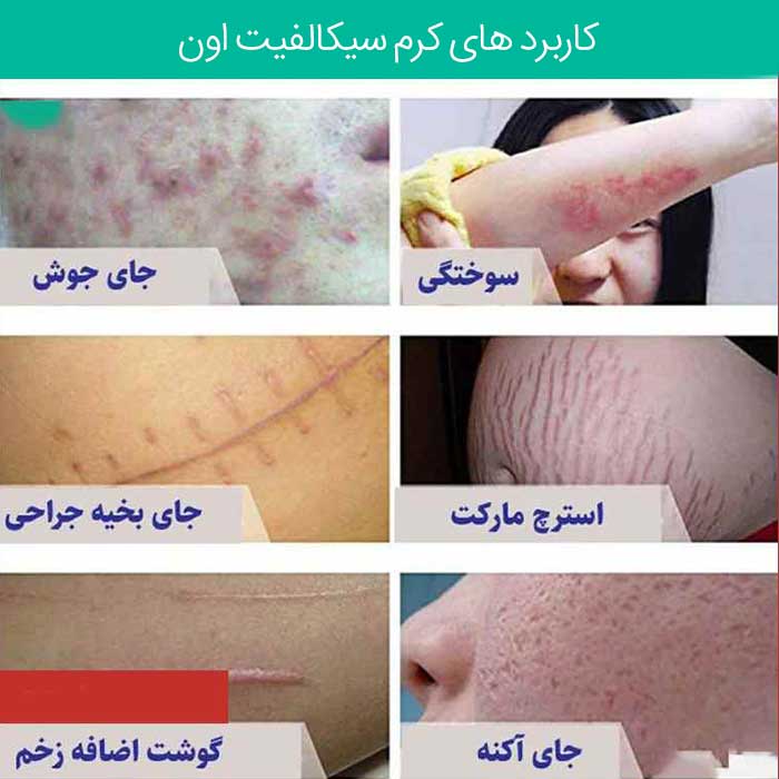 کرم ترمیم کننده سیکالفیت پلاس اون